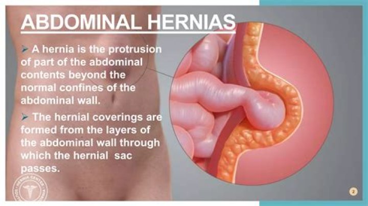 Are ab workouts bad for hernias?