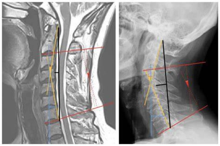 Can a cervical spine MRI detect ALS?