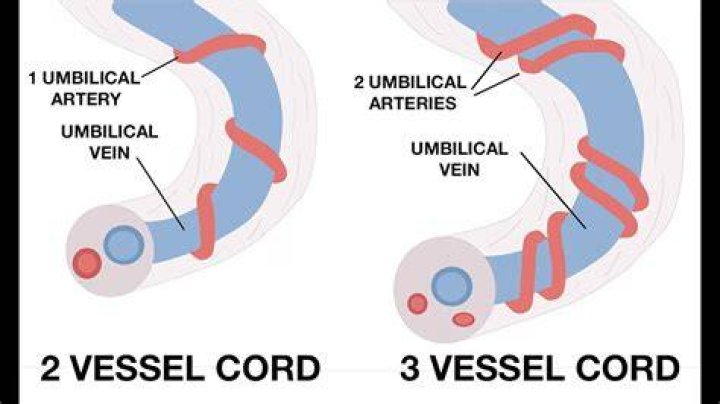 Can a two-vessel cord cause IUGR?