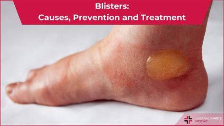 Can a virus cause blisters on tongue?