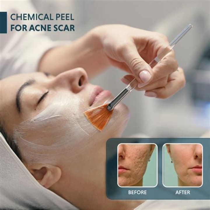 Can chemical peels get rid of tattoos?