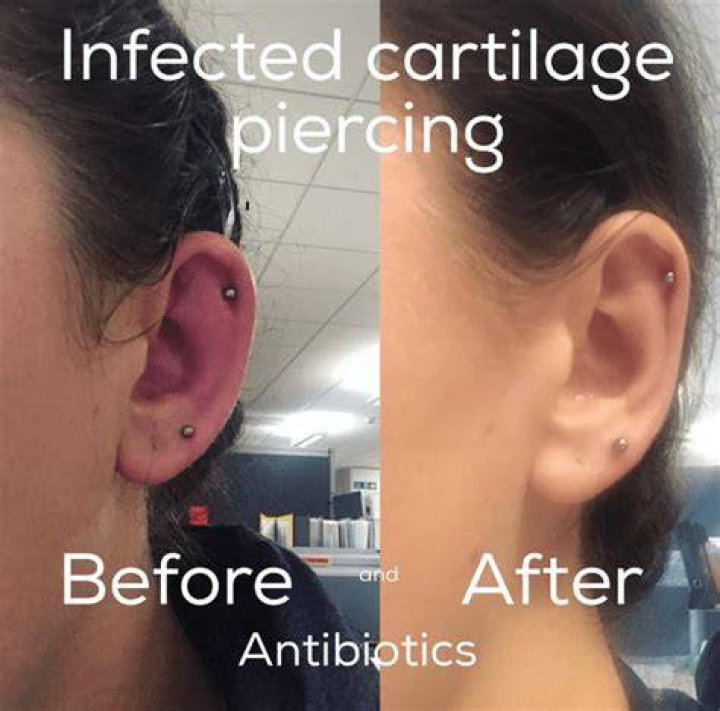 Can ear piercings get infected after years?