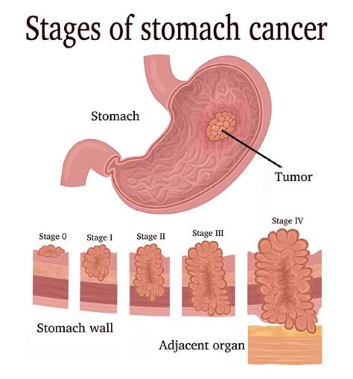 Can mesothelioma be in the stomach?
