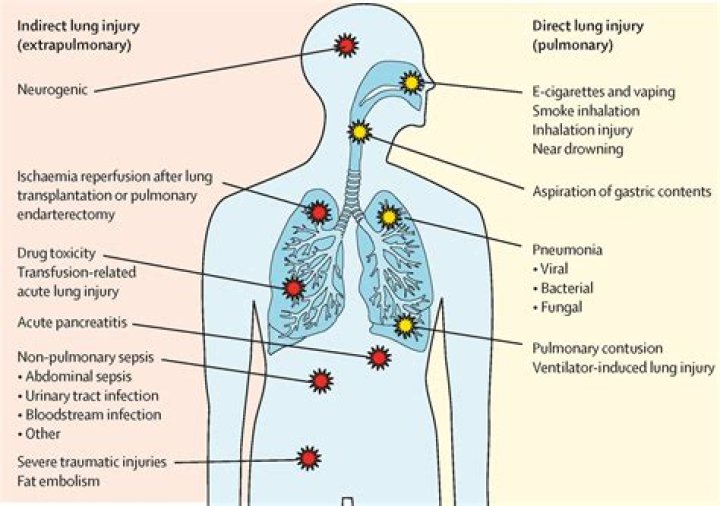 Can MS cause respiratory problems?