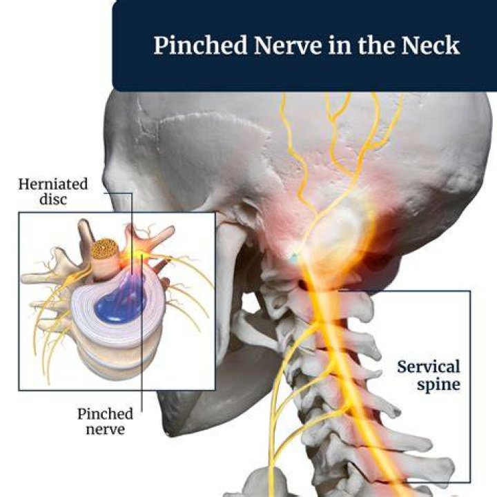 Can neck pain radiate to skull?
