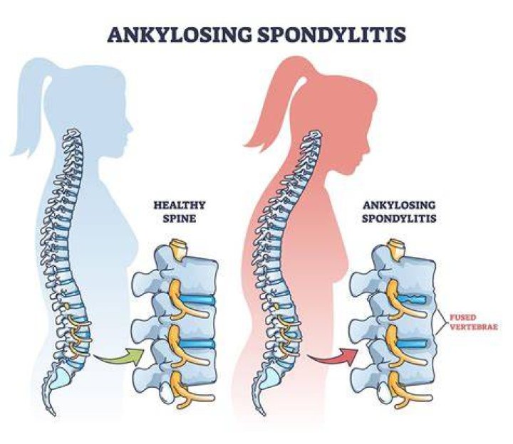 Can spondyloarthritis affect pregnancy?
