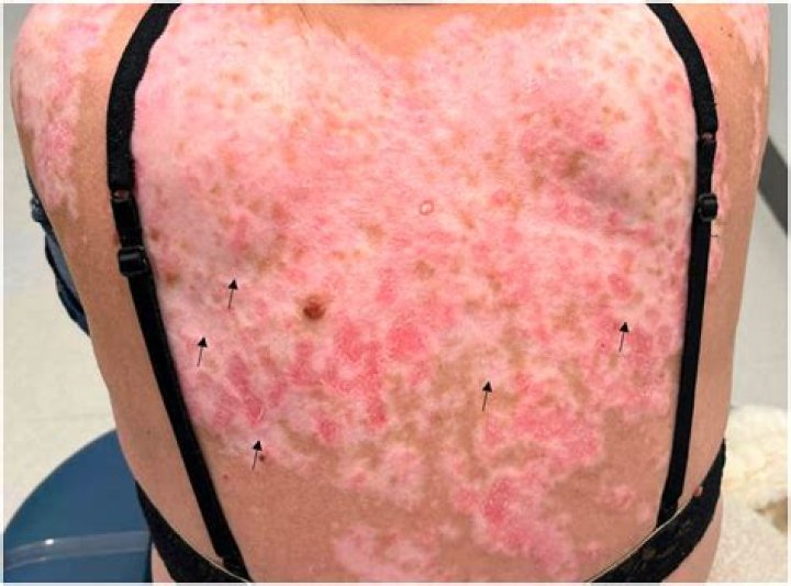 Can subacute cutaneous lupus be cured?