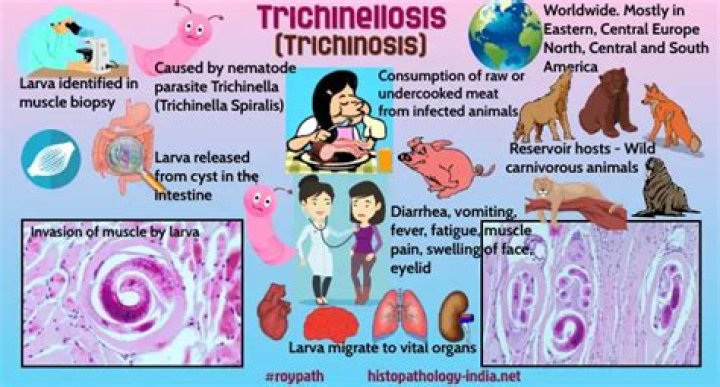 Can you get trichinosis in the US?