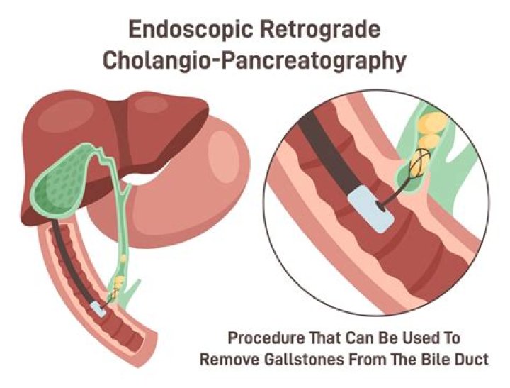 Do gastroenterologists do ERCP?