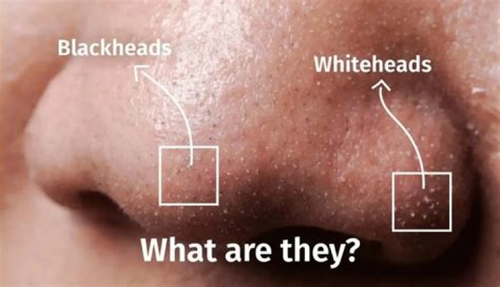 Do whiteheads go away on their own?