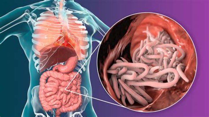 Do worms show up on endoscopy?