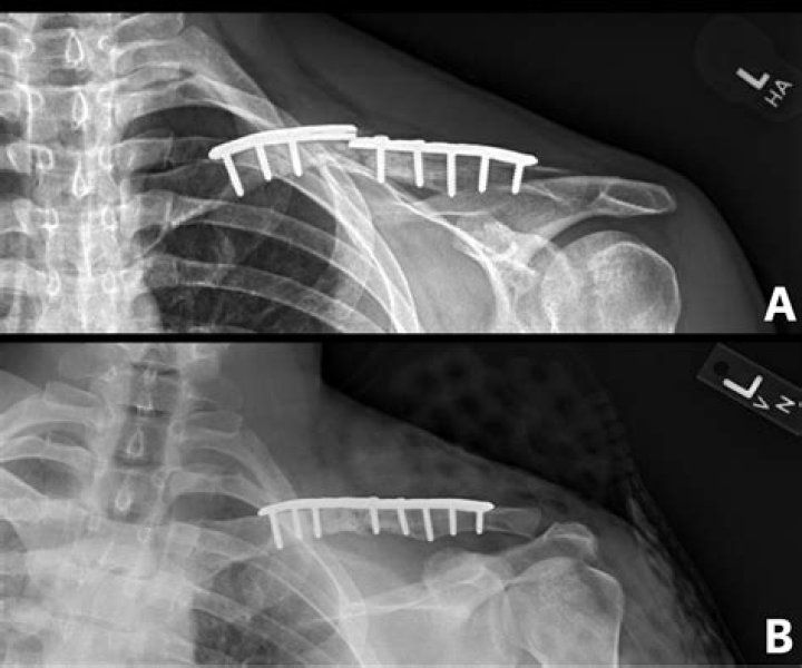 How did Tony Romo break his collarbone?