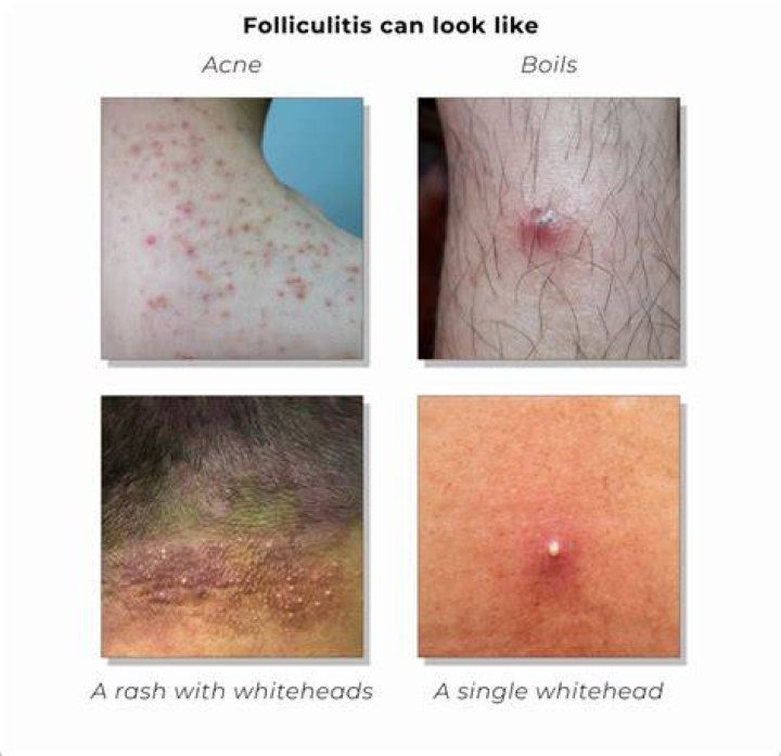 How do I get rid of folliculitis in my pubic area?
