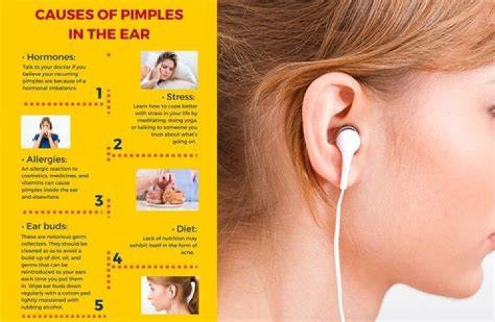 How do I stop getting pimples on my headphones?