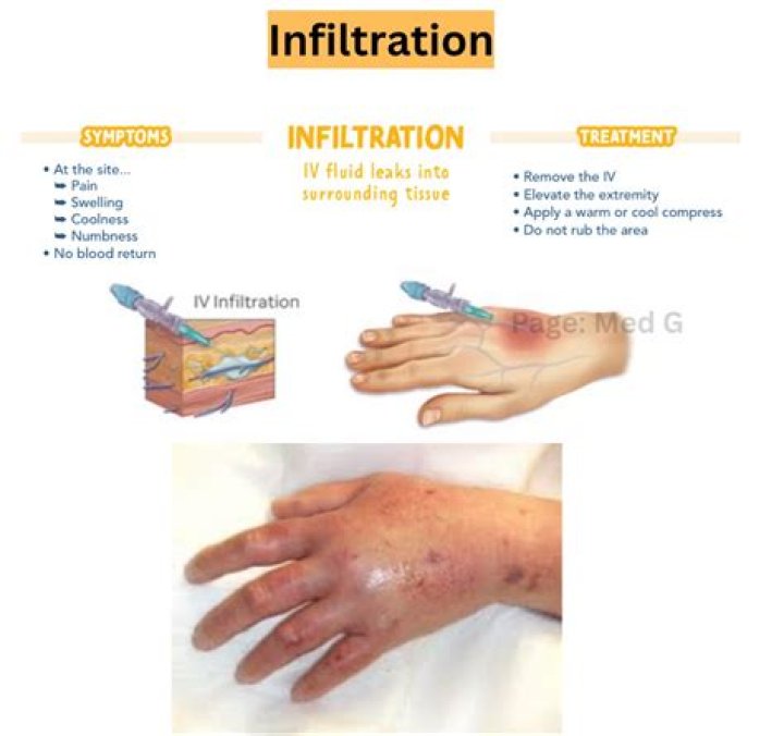 How do you describe IV infiltration?