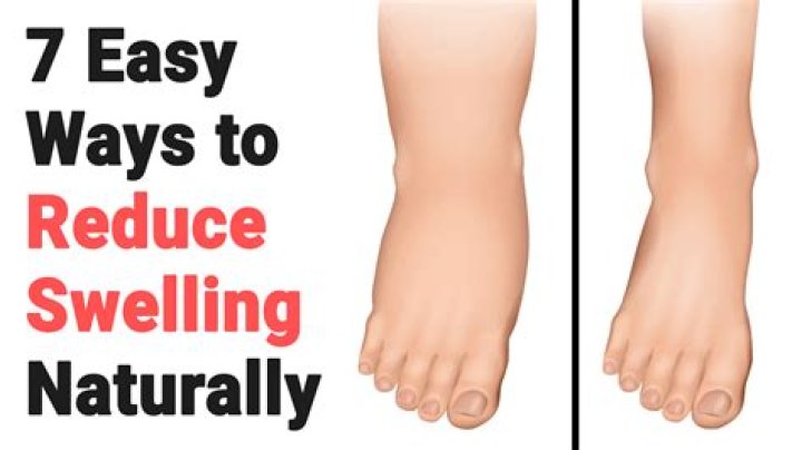 How do you reduce swelling in legs and feet after sunburn?