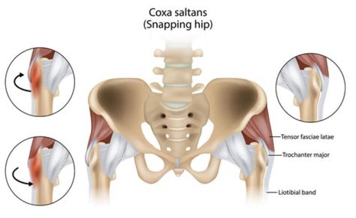 How do you treat external hip snapping?