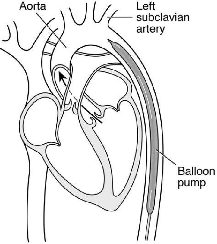 How does the intra aortic balloon pump work?