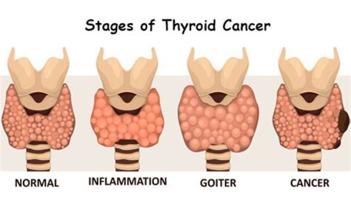 How fast does thyroid cancer grow?