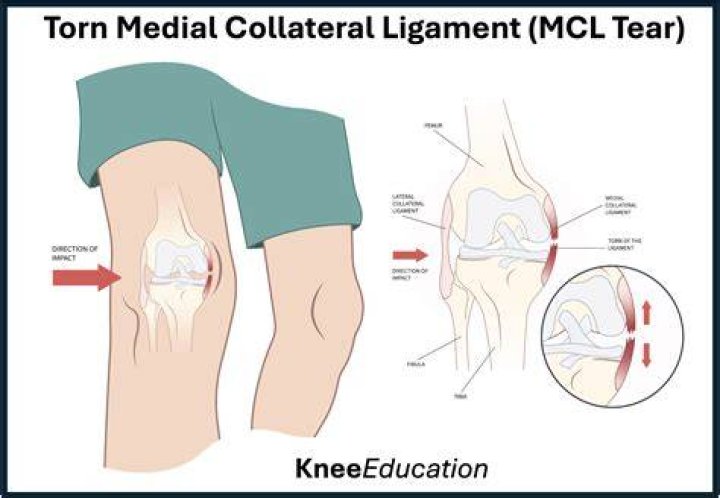 How long does a MCL and PCL take to heal?