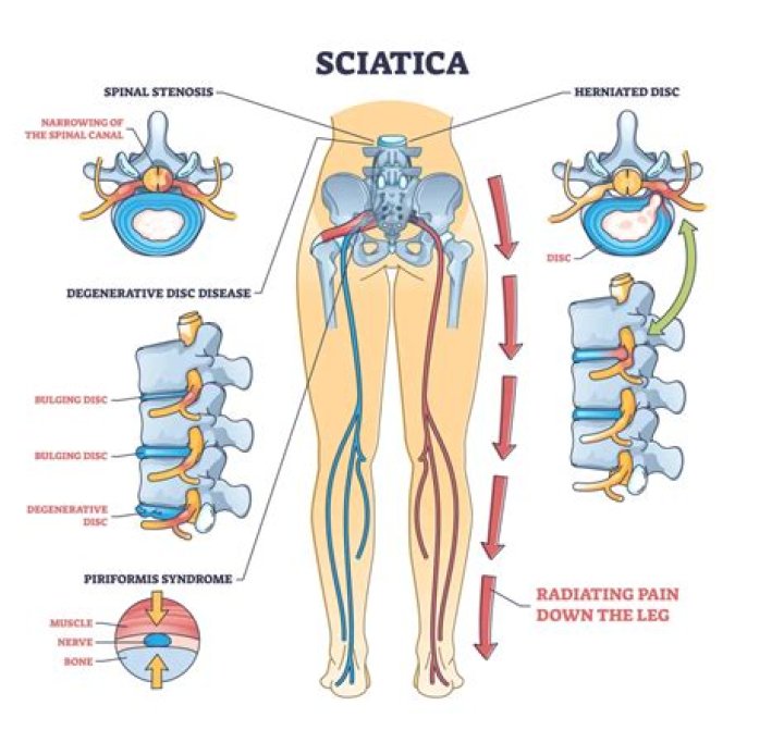 How long does it take an injured sciatic nerve to heal?