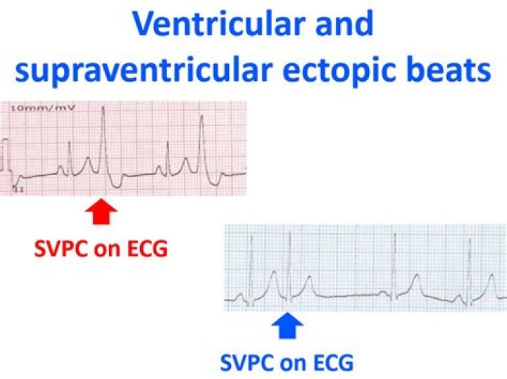 How many ventricular ectopic beats are normal in 24 hours?