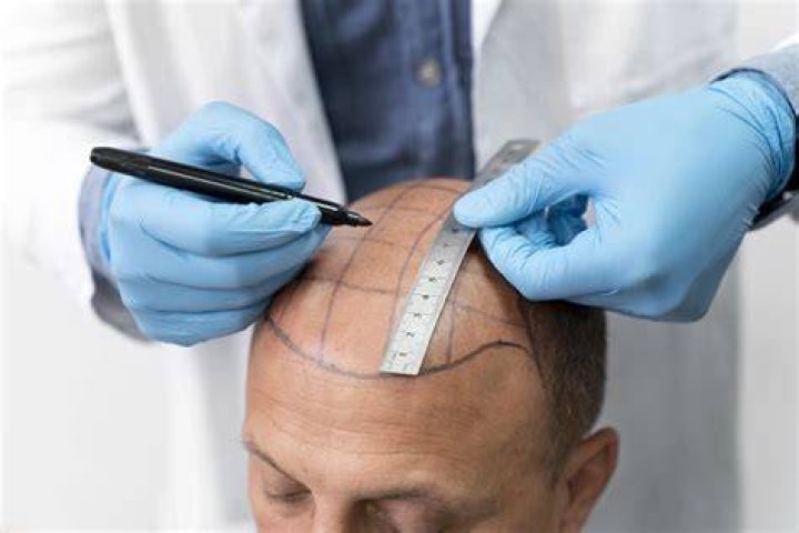 How much does the average hair restoration cost?