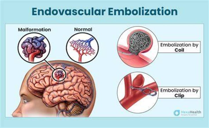 Is embolization performed in IR?