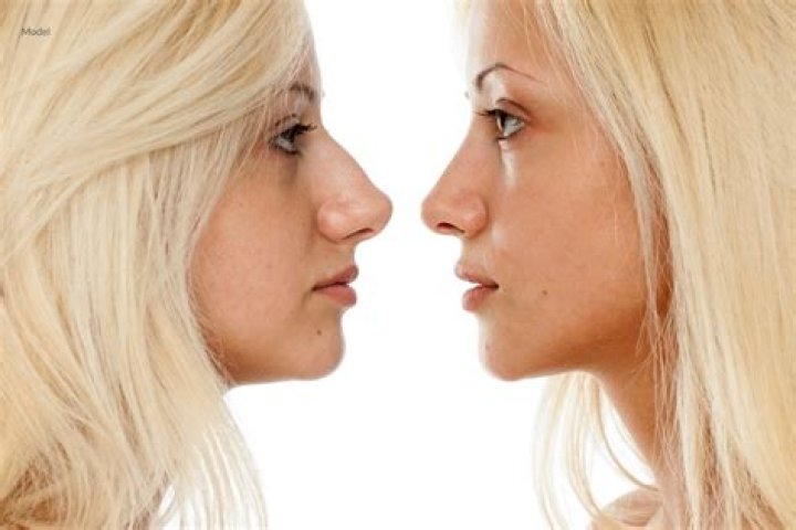 Is open rhinoplasty better than closed?