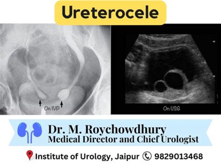 What are the symptoms of Ureterocele?