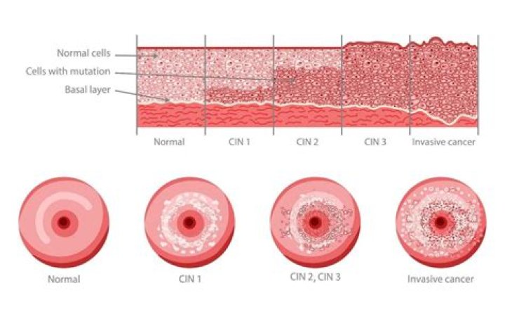 What causes atypical cells in cervix?