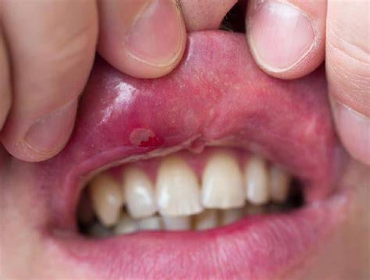 What causes mouth blisters on lips?