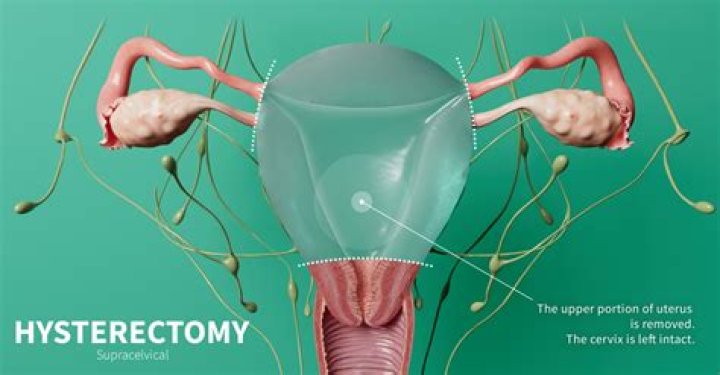 What does total vaginal hysterectomy mean?