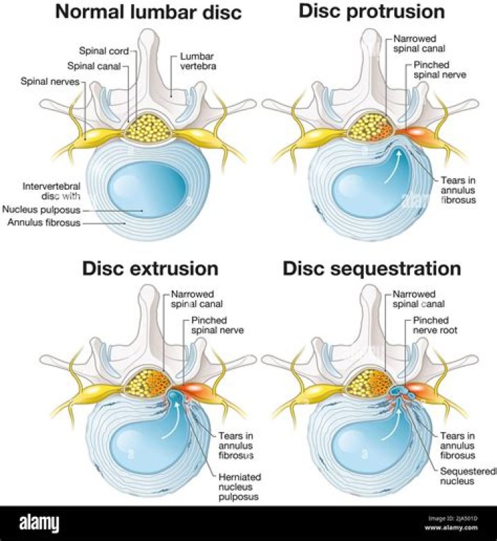 What is cervical disc protrusion?