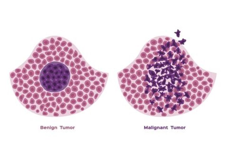 What is malignant neoplasm of unspecified ovary?