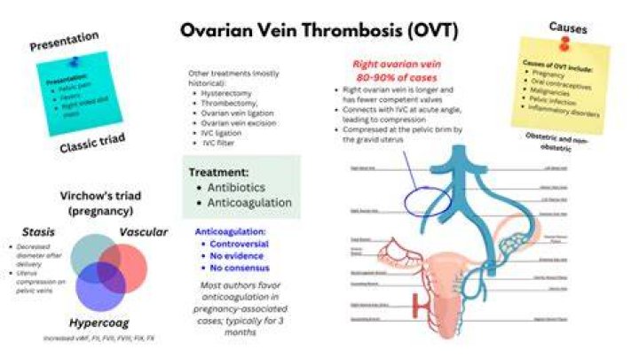 What is ovarian vein coiling?
