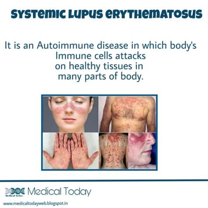 What is systemic lupus erythematosus?