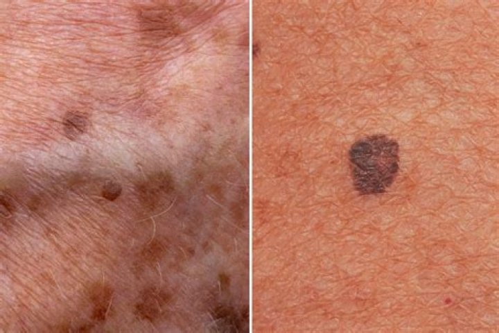 What is the difference between benign and malignant melanoma?