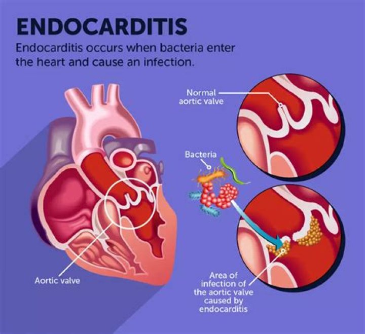 What is the most common sign of infective endocarditis?