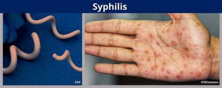 What type of organism caused syphilis?