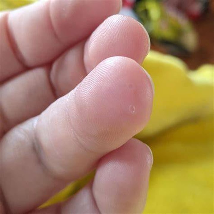 Why do I have tiny water bubbles on my skin?