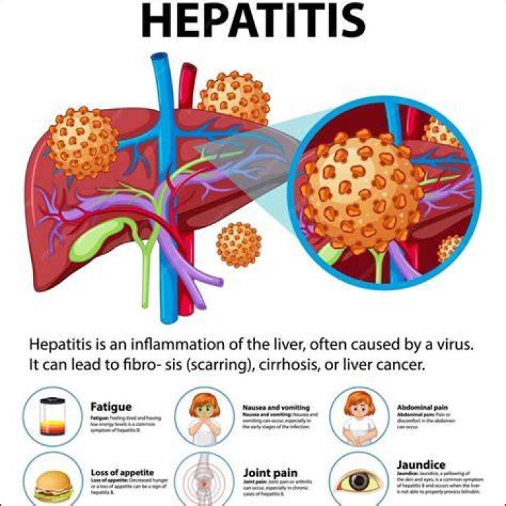 Why is hepatitis E severe in pregnancy?